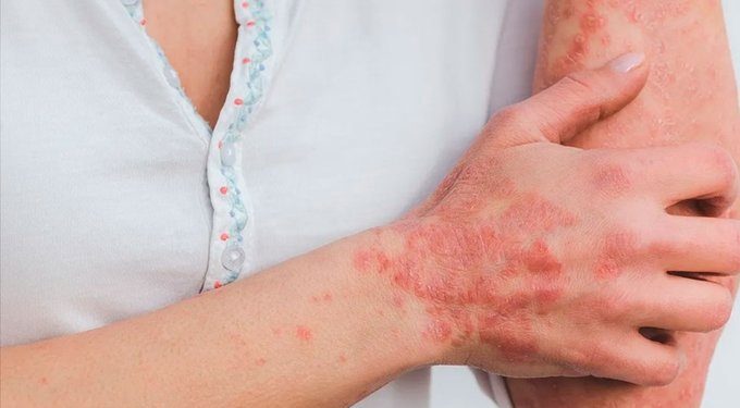 La Secretaria de Salud de Morelos confirma 2 casos de Lepra en Morelos